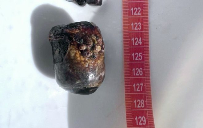 Камень аномального размера достали из кишечника женщины в Пятигорске