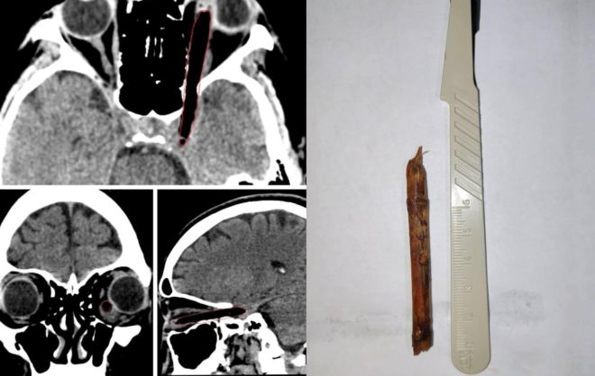 Обломок ветки длиной 8 см извлекли из глаза пациентки нейрохирурги Ставрополья
