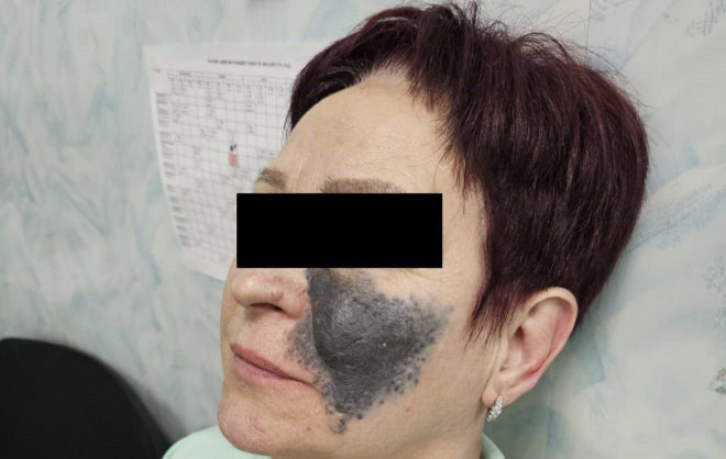 Гигантскую родинку удалили с лица жительнице Ставрополя
